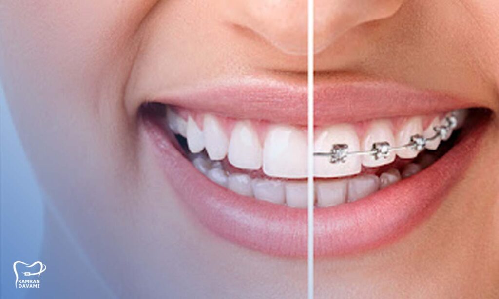 کامپوزیت بهتراست یا ارتودنسی؟ کدوم ارزون‌تر و سریع‌تره؟