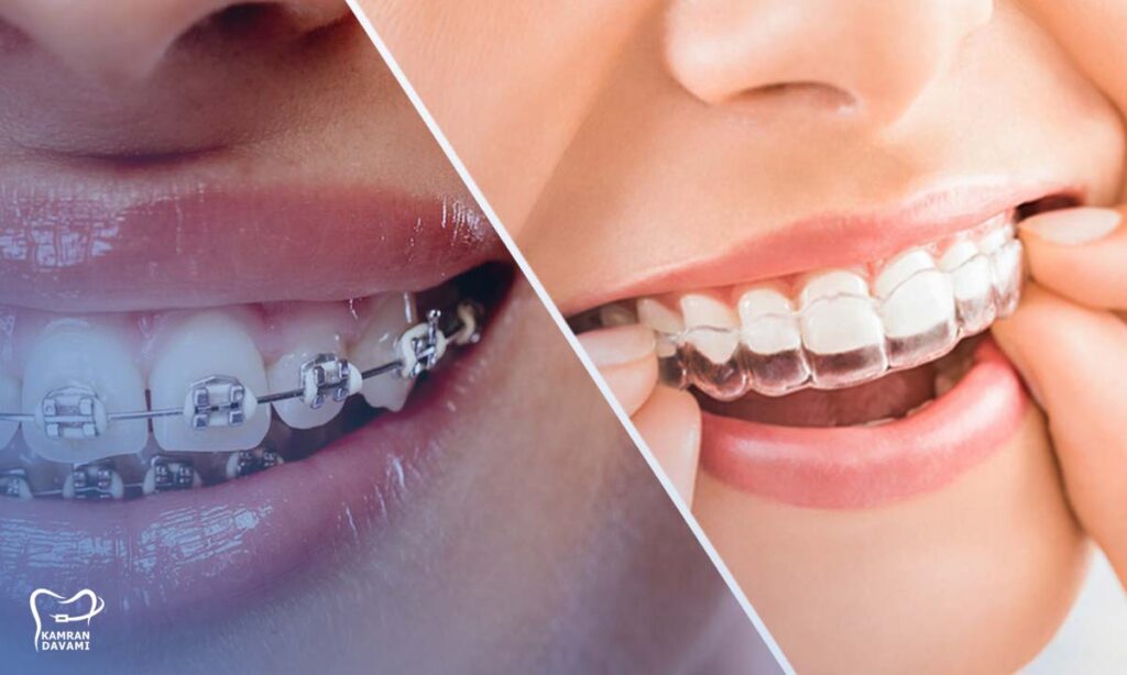ارتودنسی متحرک بهتر است یا ثابت؟ کدام درد ندارد؟