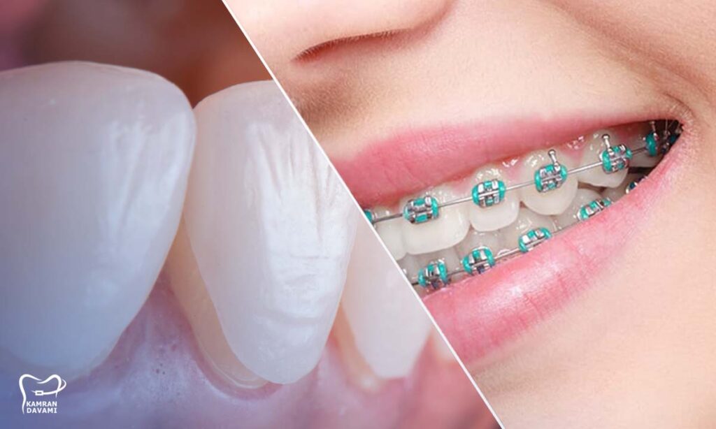 ارتودنسی بهتر است یا لمینت؟ راهنمای انتخاب صحیح