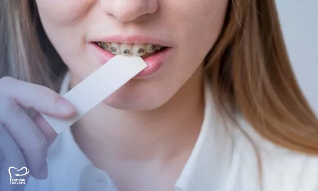 آیا با ارتودنسی میشه ادامس خورد؟