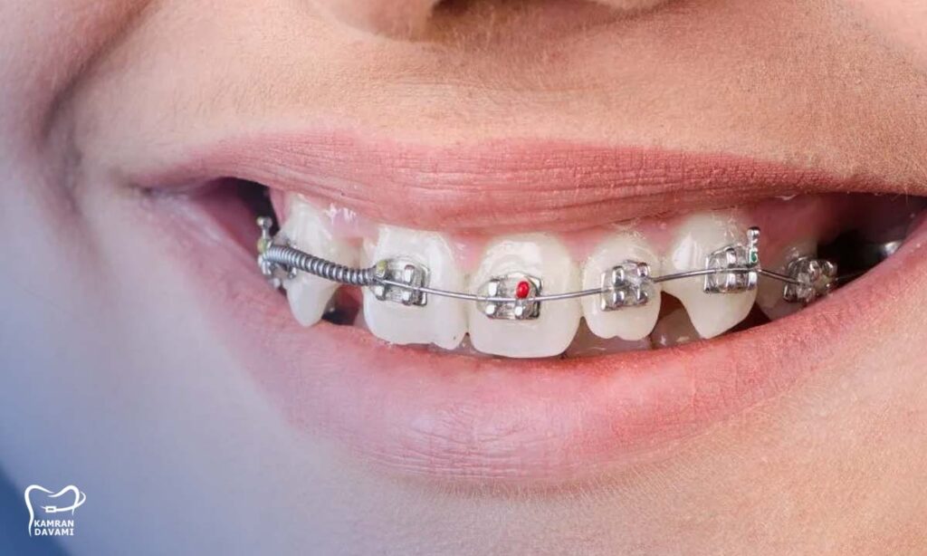 عوارض ارتودنسی اشتباه چیست؟