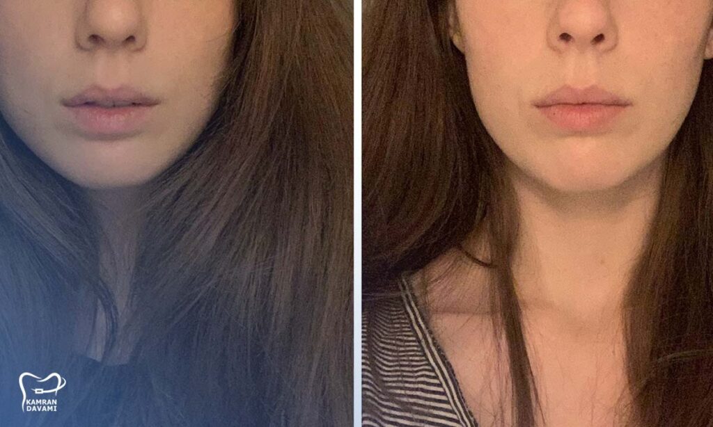 تاثیر ارتودنسی بر لاغری صورت چقدر و چگونه است؟