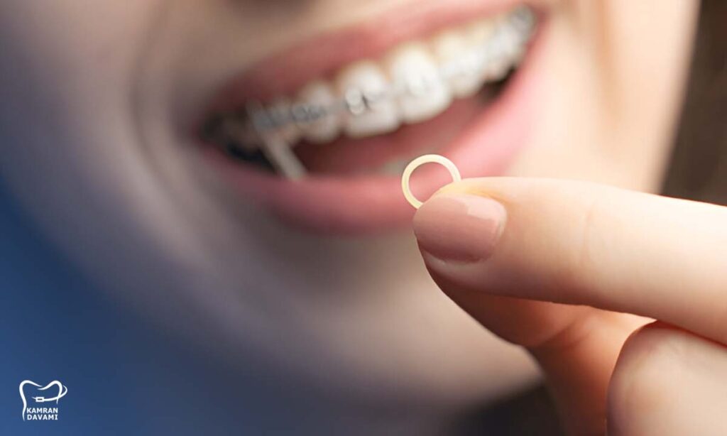 مرحله بعد از کش ارتودنسی چیست؟