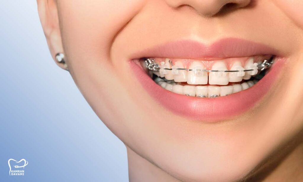 فاصله افتادن بین دندانها بعد از ارتودنسی