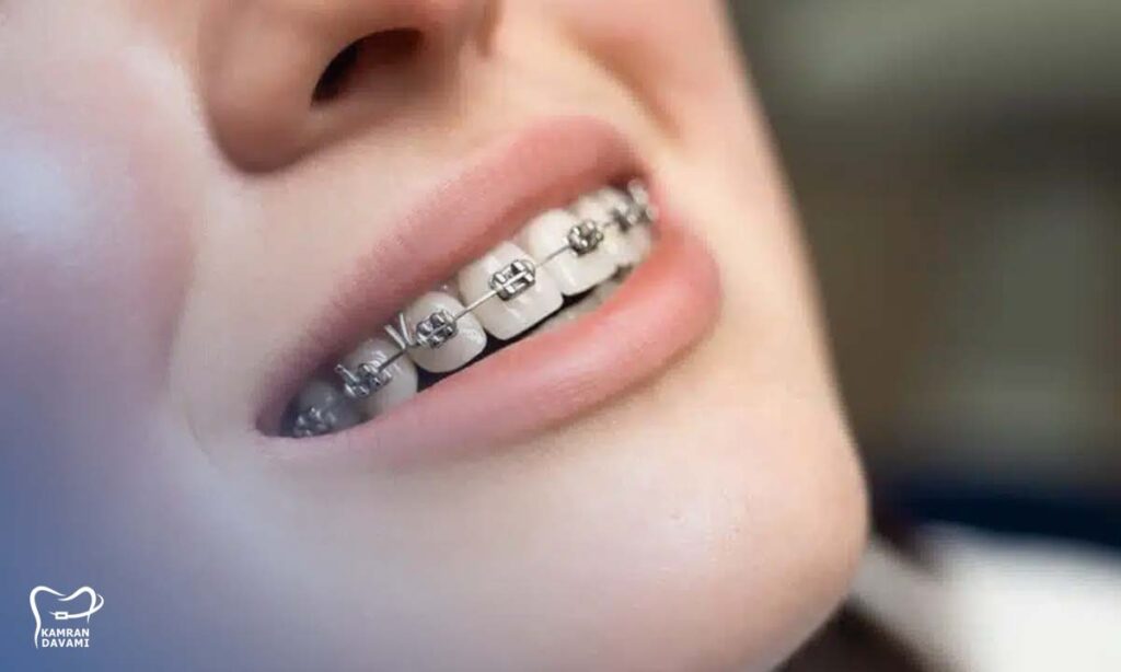 ارتودنسی بدون جراحی فک چیست؟ چگونه انجام میشود؟