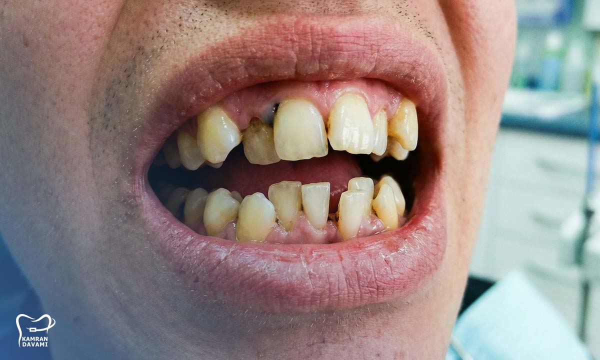 چه افرادی نیاز به ارتودنسی دارند