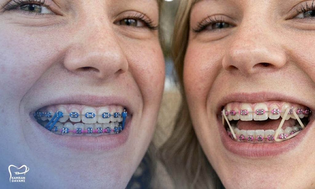 what-is-orthodontic-elastic