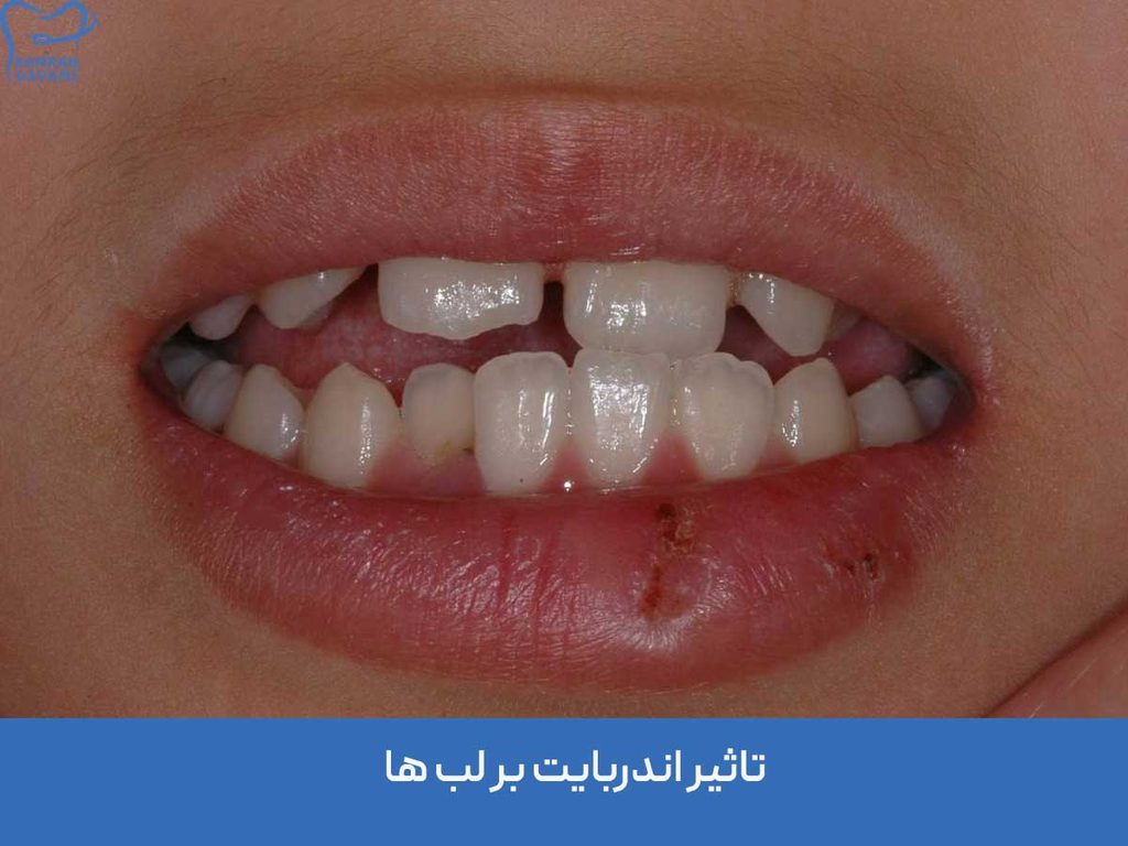 تاثیر ارتودنسی بر فرم لب