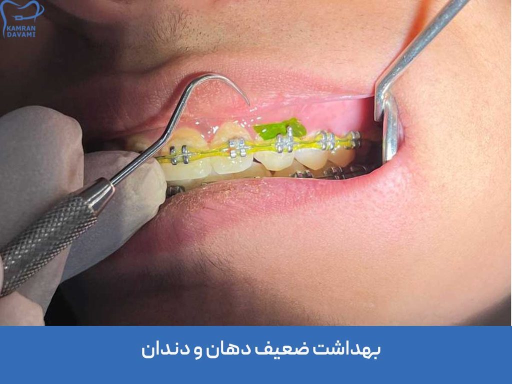 دلیل درد دندان در ارتودنسی