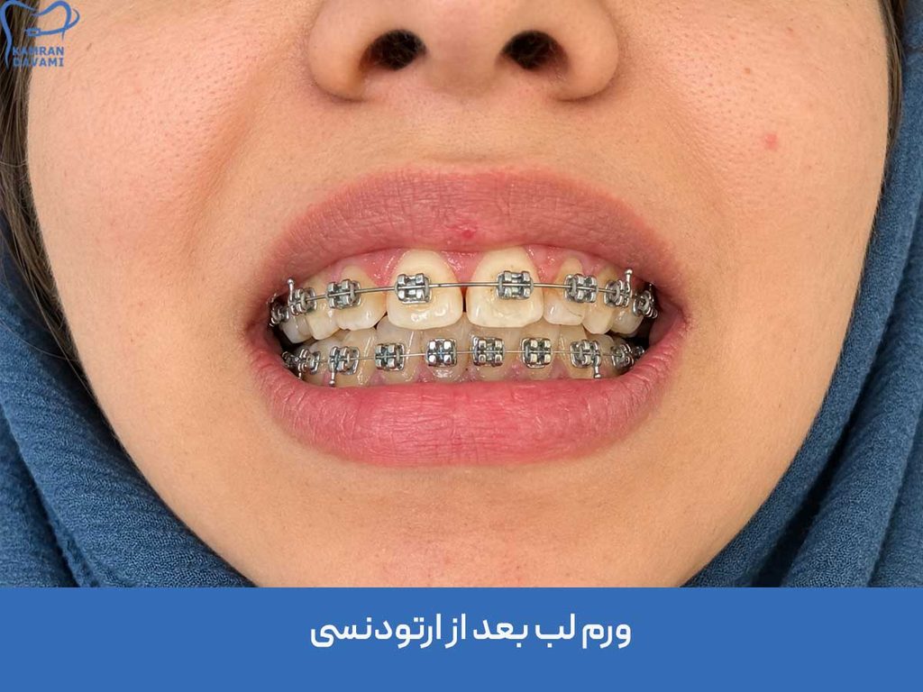 ورم لب بعد از ارتودنسی